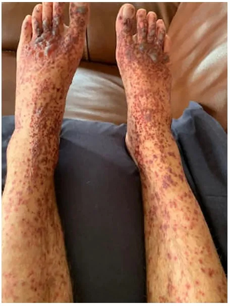 Figura 1: Lesiones cutáneas en la presentación del caso.